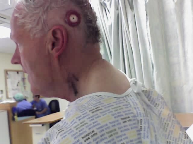 bandage removed
